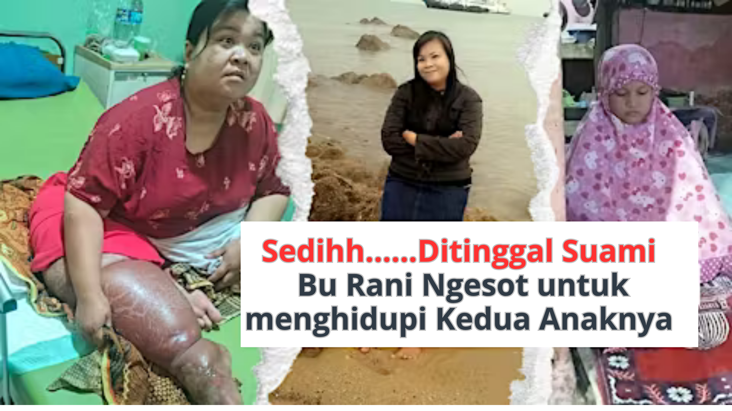 Bantu Bu Mela Sembuh dari Infeksi Tulang Kaki