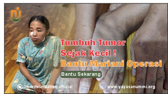 Tumbuh Tumor Sejak Kecil ! Bantu Mariani Operasi
